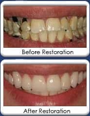 All-ceramic crowns, before & after restoration
