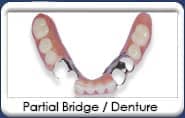 Chandler Dentist - Removable Dental Bridge 