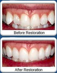 Chandler Dentist - smile makeover - before & after
